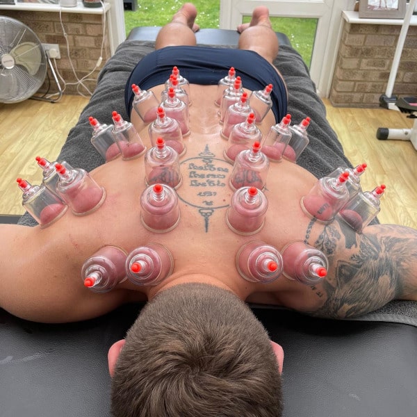 Dry Cupping Treatment